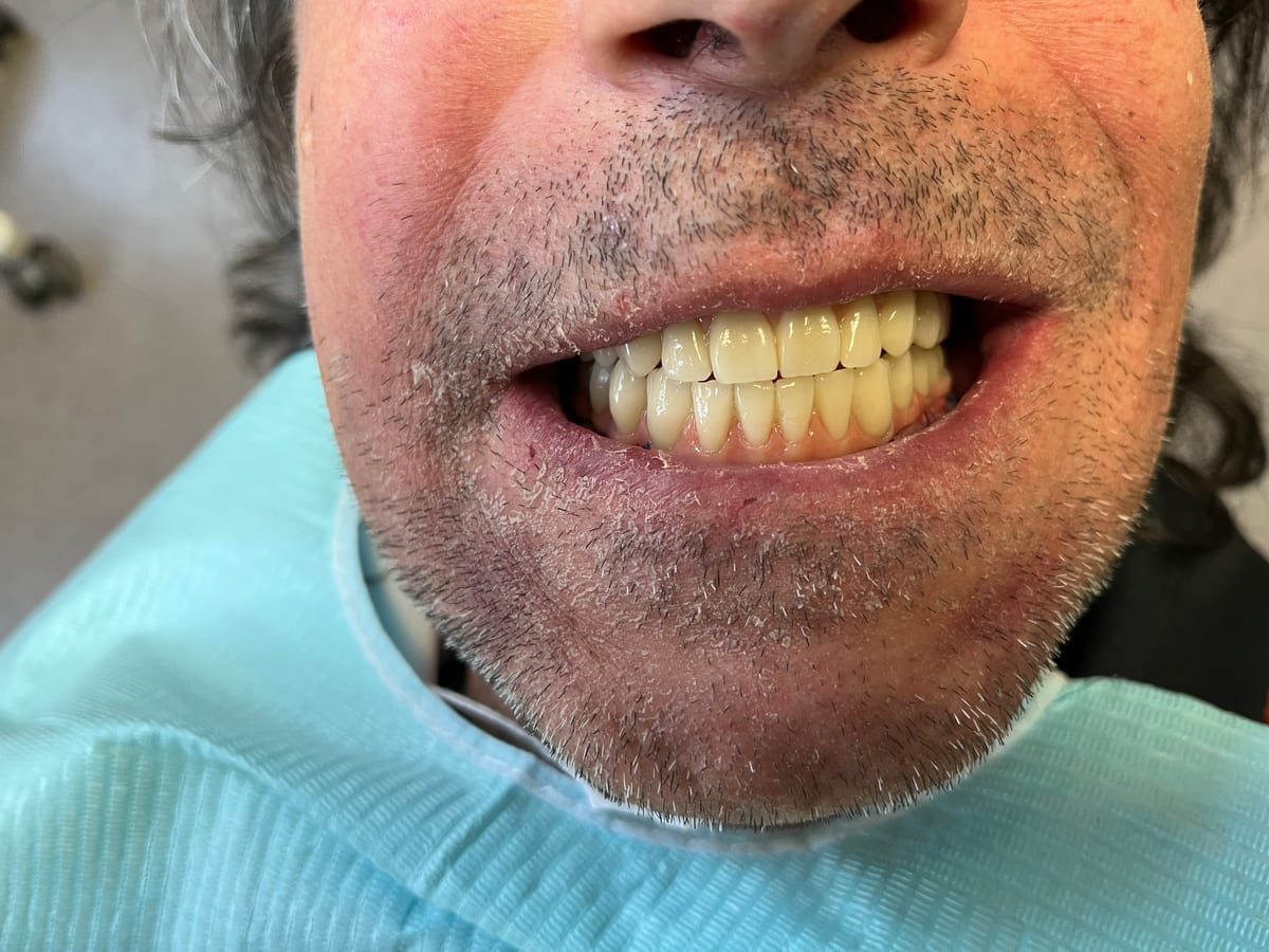Le même patient avec son bridge provisoire fixe, 24 heures après l'intervention