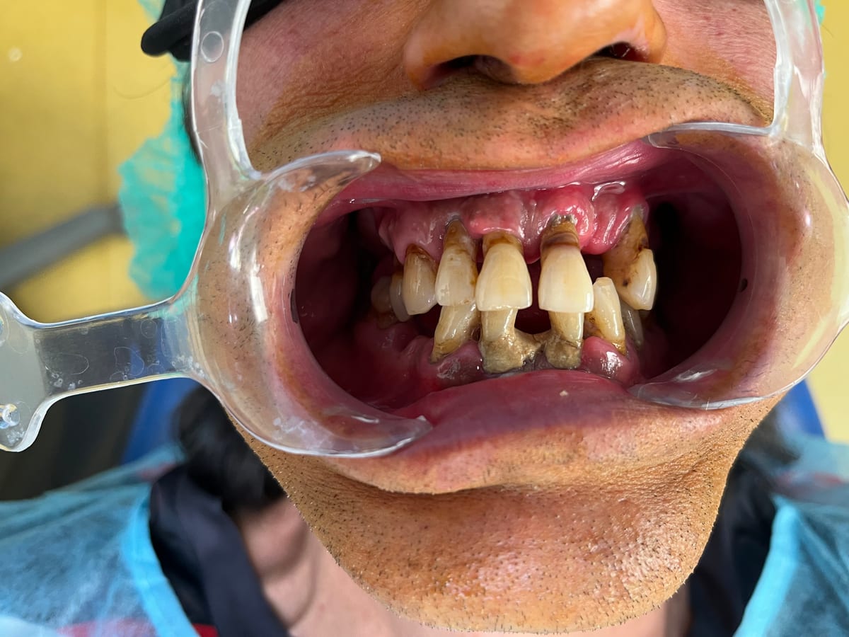 Dents très abîmées d'un patient avant l'intervention